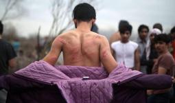 أحد الشبان المهاجرين بعد تعرضه للضرب من قبل حرس الحدود اليوناني
