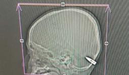 صورة أشعة تظهر إصابة طفل برصاصة طائشة في عفرين